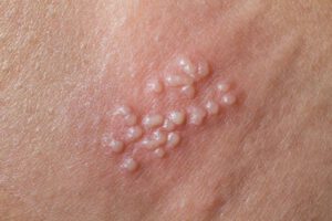 gardasil 9